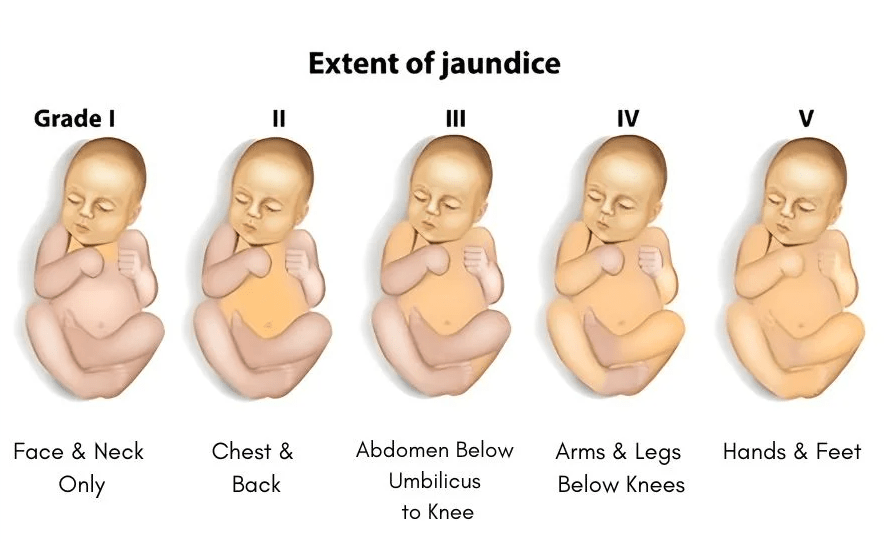 Newborn Jaundice: What Parents Need to&nbsp;Know